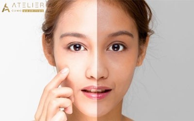 Combat the skin issues with skin whitening treatment