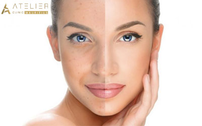 Enhance your look with the best skin whitening treatment